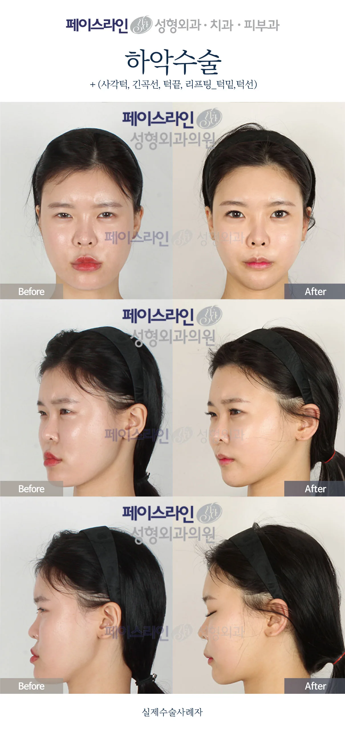 Lower jaw surgery with chin and jawline contouring at Faceline Plastic Surgery: Front, angled and profile views; before on the left and after on the right.