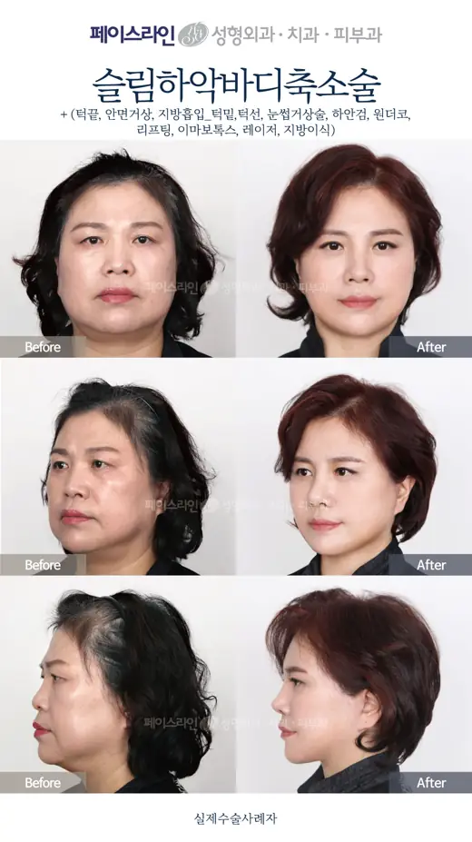Lower jaw reduction with facelift and eyelid procedures before and after at Faceline Plastic Surgery