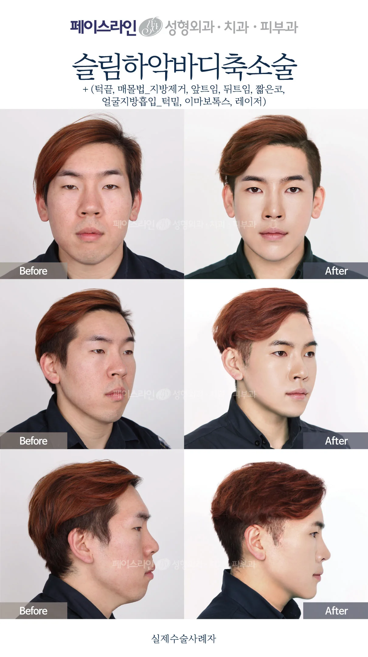 Lower jaw reduction with nose and eyelid surgery at Faceline Plastic Surgery: Front, angled and profile views; before on the left and after on the right.