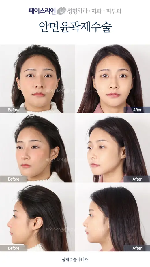 Revision facial contouring — three views before and after at Faceline Plastic Surgery