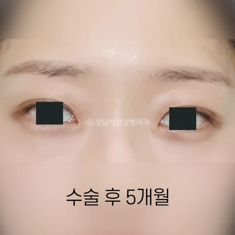 Buried-suture double eyelids: five-month comparison at Gangnam Seoyon Plastic Surgery. After buried-suture double eyelids at Gangnam Seoyon Plastic Surgery: front-view eye close-up with iris coverings. The source labels this view 5 months after surgery.