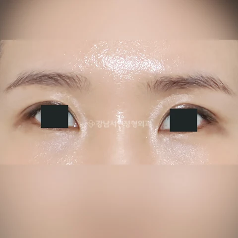 Eyelid crease raising: front-view comparison at Gangnam Seoyon Plastic Surgery. After eyelid crease raising at Gangnam Seoyon Plastic Surgery: front-view eye close-up with iris coverings.