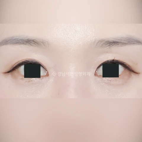 Incisional double eyelids with inner-corner surgery at Gangnam Seoyon Plastic Surgery. After incisional double eyelids & epicanthoplasty at Gangnam Seoyon Plastic Surgery: front-view eye close-up with iris coverings.