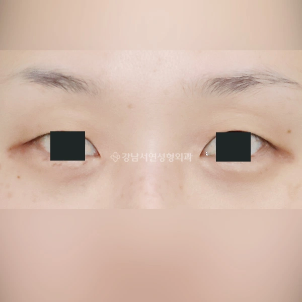 Incisional double eyelids with inner-corner surgery at Gangnam Seoyon Plastic Surgery. Before incisional double eyelids & epicanthoplasty at Gangnam Seoyon Plastic Surgery: front-view eye close-up with iris coverings.