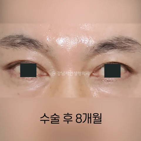 Male eyelid crease lowering: eight-month comparison at Gangnam Seoyon Plastic Surgery. After eyelid crease lowering at Gangnam Seoyon Plastic Surgery: front-view eye close-up with iris coverings. The source labels this view 8 months after surgery.