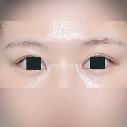 Multiple eyelid folds: correction comparison at Gangnam Seoyon Plastic Surgery. After multiple eyelid fold correction at Gangnam Seoyon Plastic Surgery: front-view eye close-up with iris coverings.
