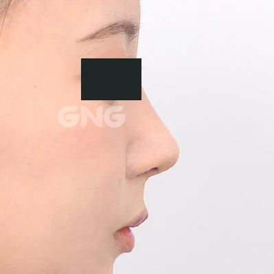 Nasal bridge and tip: profile comparison at GNG Hospital. After photograph from GNG Hospital’s numbered case 1, showing the nasal bridge and tip from the side. Eyes are covered.