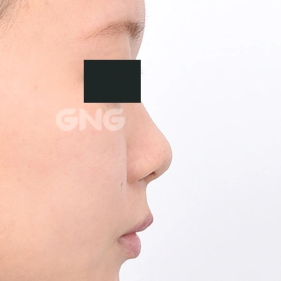 Nasal bridge and tip: profile comparison at GNG Hospital. Before photograph from GNG Hospital’s numbered case 1, showing the nasal bridge and tip from the side. Eyes are covered.