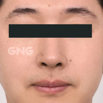 Bridge alignment: frontal comparison at GNG Hospital. After photograph from GNG Hospital’s numbered case 10, showing the bridge, tip and nostrils from the front. Eyes are covered.