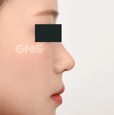 Nose and upper-lip outline: profile comparison at GNG Hospital. After photograph from GNG Hospital’s numbered case 2, showing the nasal bridge and tip from the side. Eyes are covered.
