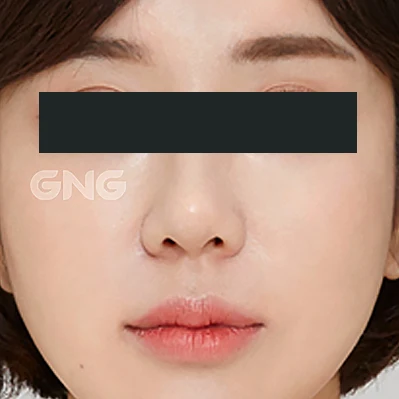 Bridge and nostril contours: front comparison at GNG Hospital. After photograph from GNG Hospital’s numbered case 3, showing the bridge, tip and nostrils from the front. Eyes are covered.