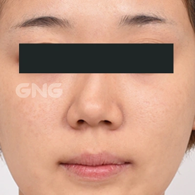 Bridge and nostril contours: front comparison at GNG Hospital. Before photograph from GNG Hospital’s numbered case 3, showing the bridge, tip and nostrils from the front. Eyes are covered.