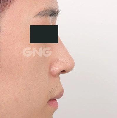Bridge contour: side-view comparison at GNG Hospital. After photograph from GNG Hospital’s numbered case 4, showing the nasal bridge and tip from the side. Eyes are covered.