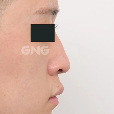 Bridge contour: side-view comparison at GNG Hospital. Before photograph from GNG Hospital’s numbered case 4, showing the nasal bridge and tip from the side. Eyes are covered.