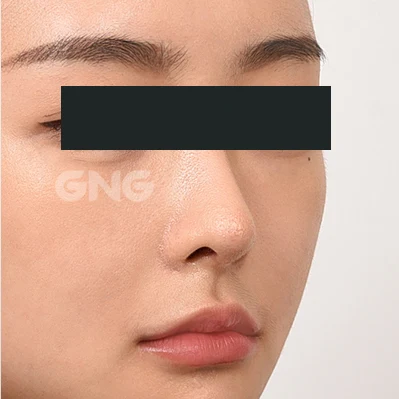 Bridge-to-tip transition: angled comparison at GNG Hospital. After photograph from GNG Hospital’s numbered case 5, showing the nose and surrounding contours at an angle. Eyes are covered.
