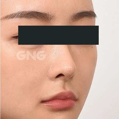 Bridge-to-tip transition: angled comparison at GNG Hospital. After photograph from GNG Hospital’s numbered case 5, showing the nose and surrounding contours at an angle. Eyes are covered.