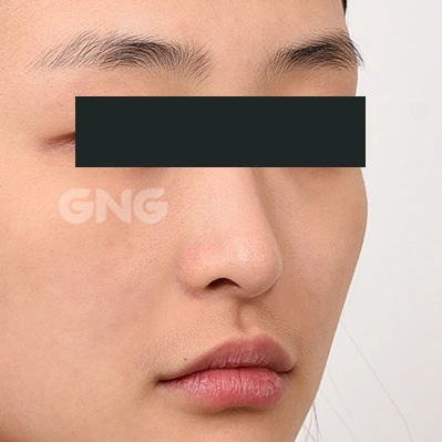 Bridge-to-tip transition: angled comparison at GNG Hospital. Before photograph from GNG Hospital’s numbered case 5, showing the nose and surrounding contours at an angle. Eyes are covered.