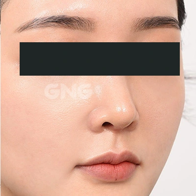 Nasal tip and cheek relationship: angled comparison at GNG Hospital. After photograph from GNG Hospital’s numbered case 6, showing the nose and surrounding contours at an angle. Eyes are covered.