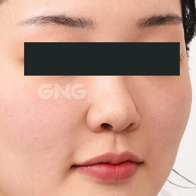 Nasal tip and cheek relationship: angled comparison at GNG Hospital. Before photograph from GNG Hospital’s numbered case 6, showing the nose and surrounding contours at an angle. Eyes are covered.