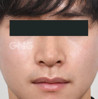 Nasal outline: frontal comparison at GNG Hospital. After photograph from GNG Hospital’s numbered case 7, showing the bridge, tip and nostrils from the front. Eyes are covered.