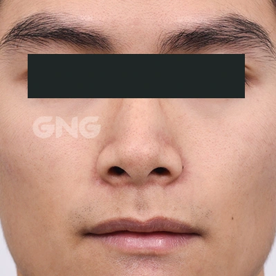 Nasal outline: frontal comparison at GNG Hospital. Before photograph from GNG Hospital’s numbered case 7, showing the bridge, tip and nostrils from the front. Eyes are covered.