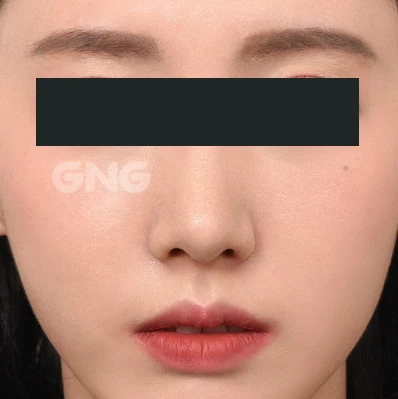 Tip and nostril detail: frontal comparison at GNG Hospital. After photograph from GNG Hospital’s numbered case 8, showing the bridge, tip and nostrils from the front. Eyes are covered.