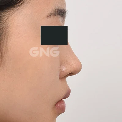 Nose-to-lip proportions: side-profile comparison at GNG Hospital. After photograph from GNG Hospital’s numbered case 9, showing the nasal bridge and tip from the side. Eyes are covered.