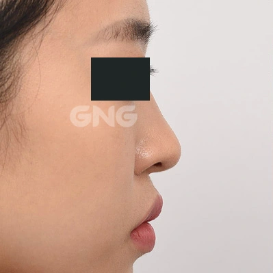 Nose-to-lip proportions: side-profile comparison at GNG Hospital. Before photograph from GNG Hospital’s numbered case 9, showing the nasal bridge and tip from the side. Eyes are covered.