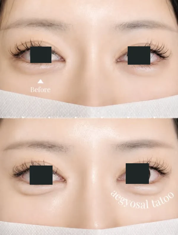 Aegyo-sal permanent makeup: under-eye detail at Golden Balance Clinic. Before above and aegyo-sal permanent makeup below, with coverings over the irises and the under-eye contours visible.
