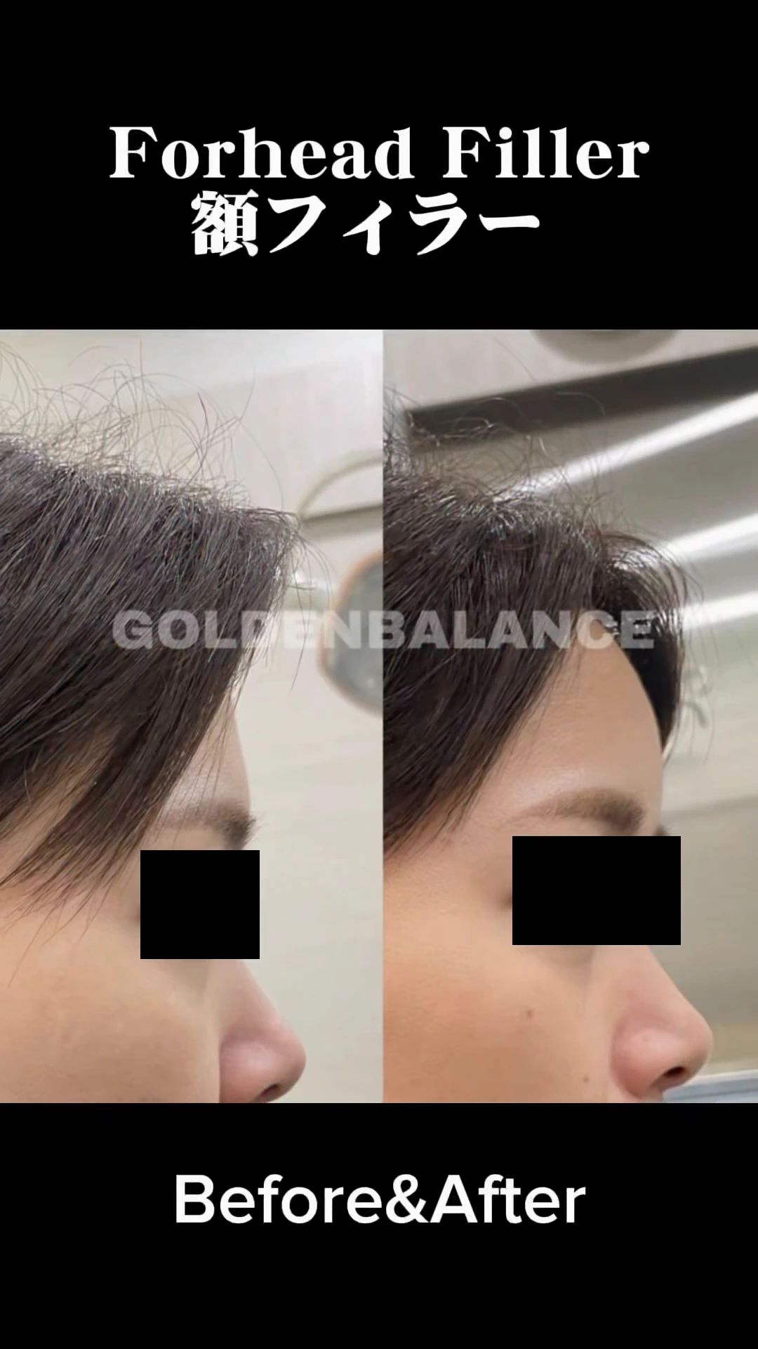 Forehead filler: side-profile video at Golden Balance Clinic. Still from the clinic’s forehead-filler video, with side profiles shown left and right and eyes covered.