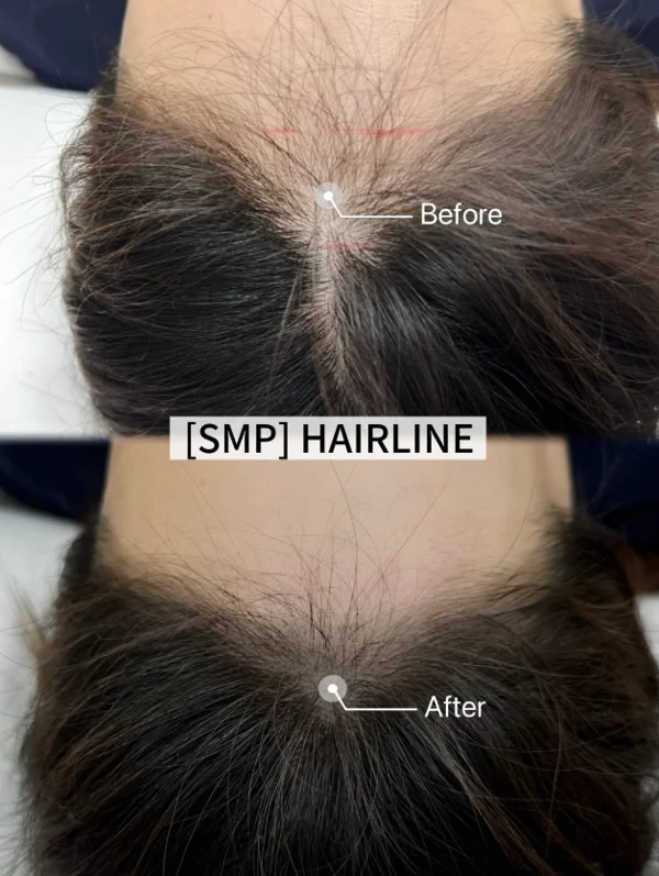 Hairline pigmentation: frontal scalp comparison at Golden Balance Clinic. Frontal scalp before above and after below, with arrows marking the hairline pigmentation area.