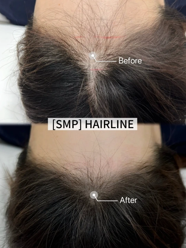 Hairline pigmentation: frontal scalp comparison at Golden Balance Clinic. Frontal scalp before above and after below, with arrows marking the hairline pigmentation area.
