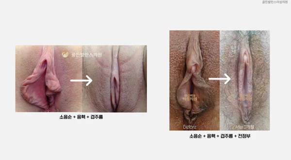 Labiaplasty: two clinical comparisons at Golden Balance Clinic. Two labiaplasty comparison pairs with left-to-right arrows; the right pair identifies a two-month follow-up.