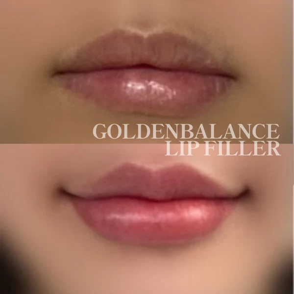 Lip filler: upper and lower lip contours at Golden Balance Clinic. Lip close-ups arranged above and below, from Golden Balance’s lip-filler collection.