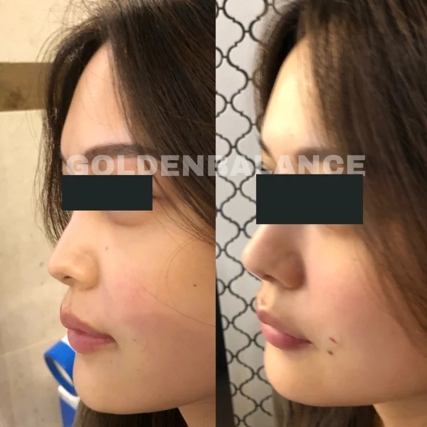 Nose filler: angled bridge and tip views at Golden Balance Clinic. Angled nose views displayed side by side in the clinic-supplied order, with eyes covered.
