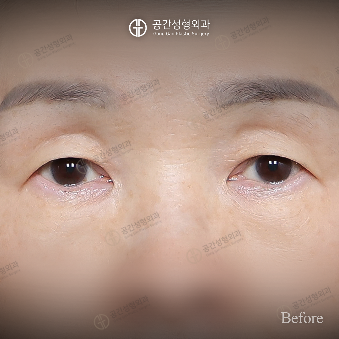 Brow lift — six-month comparison at Gong Gan Plastic Surgery. Gong Gan Plastic Surgery, Seoul: brow lift — six-month comparison, front eye-area view. Before, as labelled in the supplied photograph.