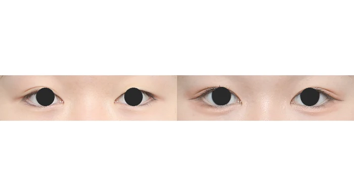 Upper-eyelid folds: close-up comparison at Gong Gan Plastic Surgery. Eye close-ups shown side by side in the clinic-supplied order. Procedure and follow-up timing are not specified.