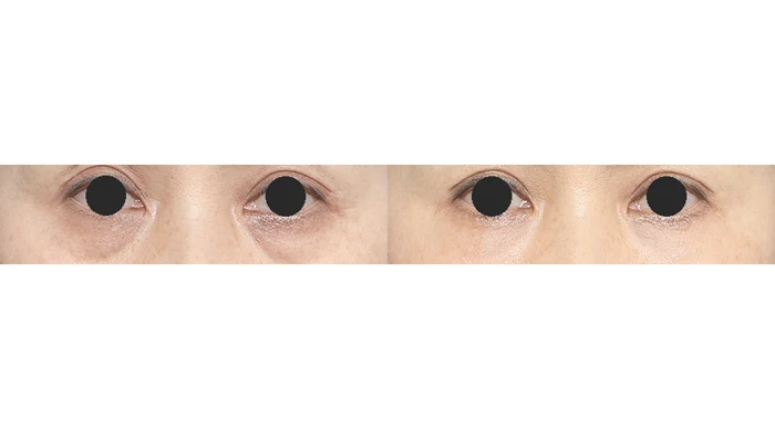 Upper and lower eyelids: close-up comparison at Gong Gan Plastic Surgery. Eye close-ups shown side by side in the clinic-supplied order. Procedure and follow-up timing are not specified.