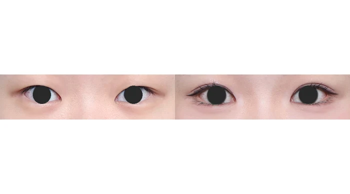 Eyelid contours and lash line: close-up comparison at Gong Gan Plastic Surgery. Eye close-ups shown side by side in the clinic-supplied order. Procedure and follow-up timing are not specified.