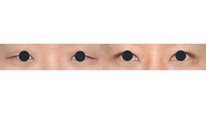 Upper-eyelid opening: close-up comparison at Gong Gan Plastic Surgery. Eye close-ups shown side by side in the clinic-supplied order. Procedure and follow-up timing are not specified.