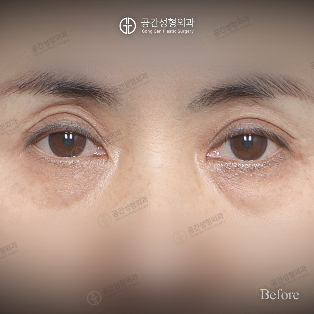 Lower blepharoplasty — one-month comparison at Gong Gan Plastic Surgery. Gong Gan Plastic Surgery, Seoul: lower blepharoplasty — one-month comparison, front eye-area view. Before, as labelled in the supplied photograph.
