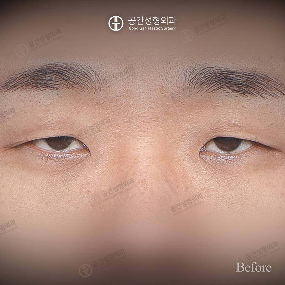 Men’s eyelid surgery — five-month comparison at Gong Gan Plastic Surgery. Gong Gan Plastic Surgery, Seoul: men’s eyelid surgery — five-month comparison, front eye-area view. Before, as labelled in the supplied photograph.