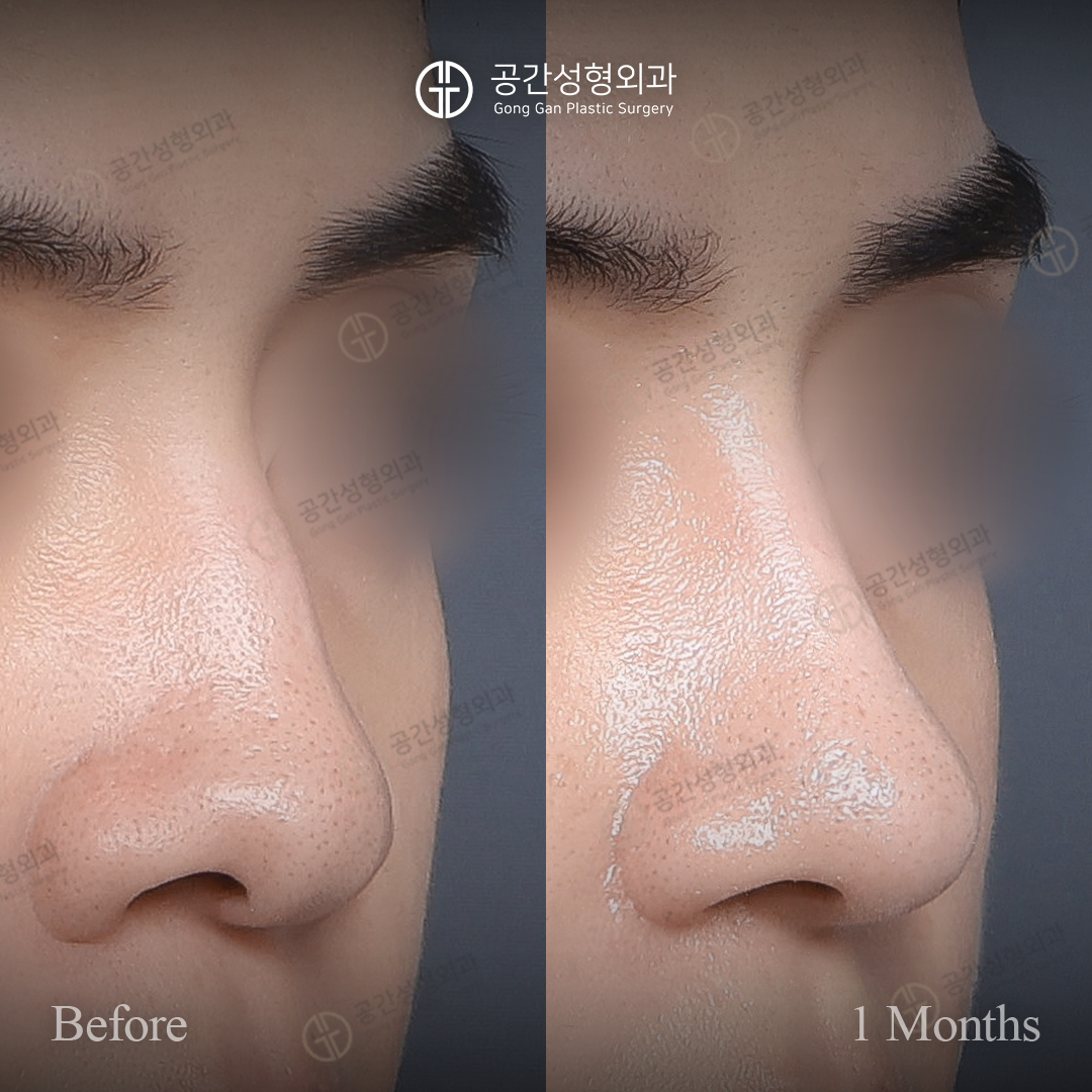 Men’s rhinoplasty — one-month collection 01 at Gong Gan Plastic Surgery. Gong Gan Plastic Surgery, Seoul: men’s rhinoplasty — one-month collection 01, angled view. Before and 1 month after, as labelled in the supplied photograph.