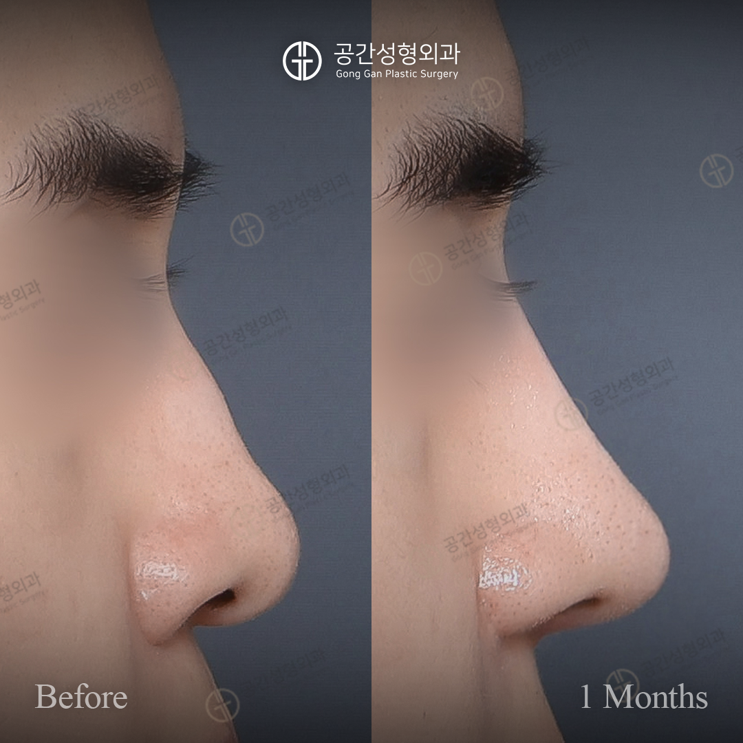 Men’s rhinoplasty — one-month collection 01 at Gong Gan Plastic Surgery. Gong Gan Plastic Surgery, Seoul: men’s rhinoplasty — one-month collection 01, side profile. Before and 1 month after, as labelled in the supplied photograph.