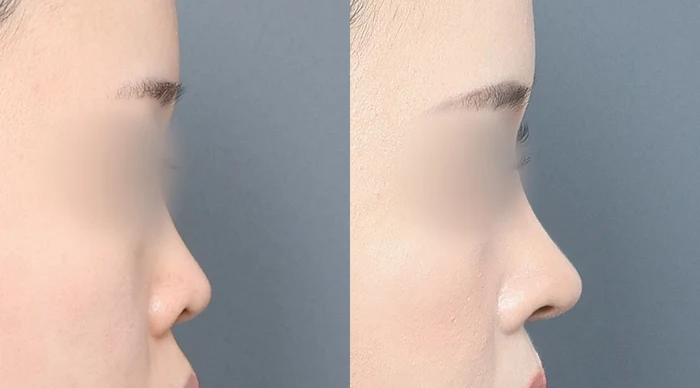Nasal bridge and tip: side-profile comparison at Gong Gan Plastic Surgery. Nose profiles shown side by side in the clinic-supplied order. Procedure and follow-up timing are not specified.