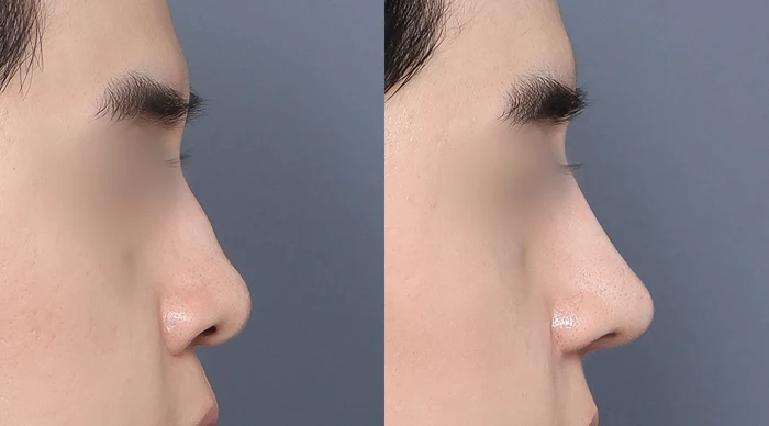 Nose profile: bridge-to-tip contour at Gong Gan Plastic Surgery. Nose profiles shown side by side in the clinic-supplied order. Procedure and follow-up timing are not specified.
