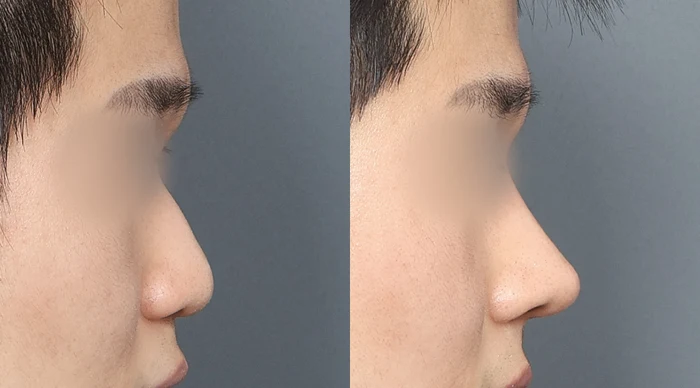 Nose and upper lip: side-profile comparison at Gong Gan Plastic Surgery. Nose profiles shown side by side in the clinic-supplied order. Procedure and follow-up timing are not specified.