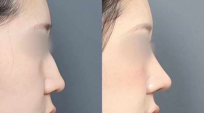 Nasal outline: close side-profile comparison at Gong Gan Plastic Surgery. Nose profiles shown side by side in the clinic-supplied order. Procedure and follow-up timing are not specified.