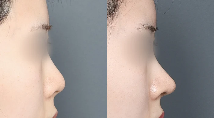 Bridge, tip and nostril: profile comparison at Gong Gan Plastic Surgery. Nose profiles shown side by side in the clinic-supplied order. Procedure and follow-up timing are not specified.