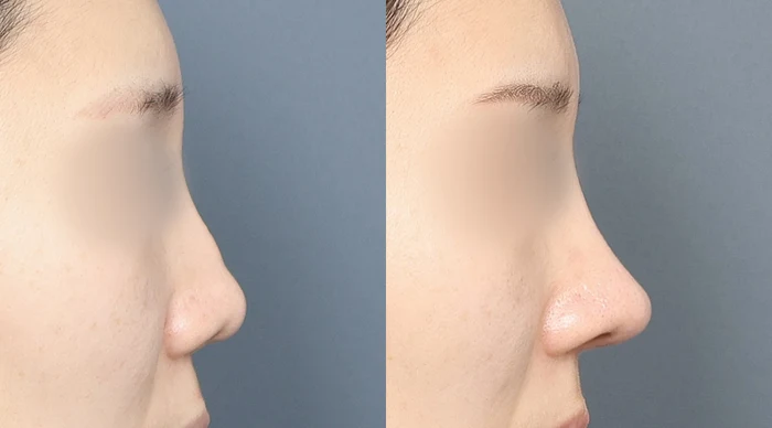 Nose profile and surrounding proportions at Gong Gan Plastic Surgery. Nose profiles shown side by side in the clinic-supplied order. Procedure and follow-up timing are not specified.